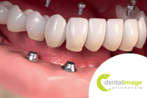 dental implants in tijuana